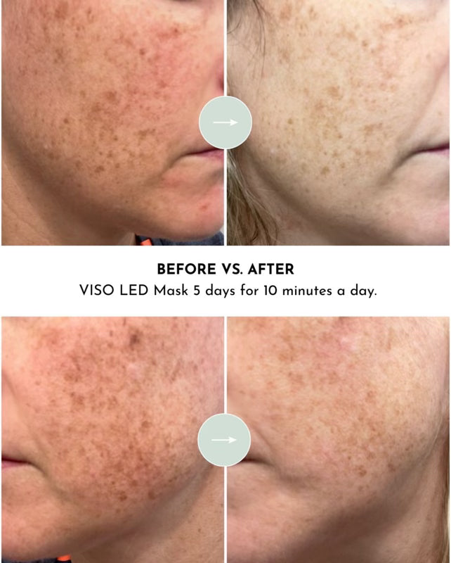 Lumara VISO Red Light Therapy Mask